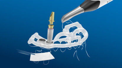 Making implantology simple with the MIS digital workflow