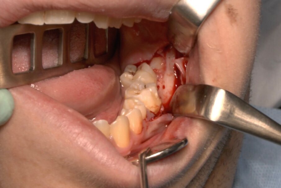 Fig. 4_Scheletrizzazione con visione della corone del 3.8.