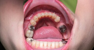 ЕС подкрепя забраната на употребата на амалгама при деца, бременни и кърмачки