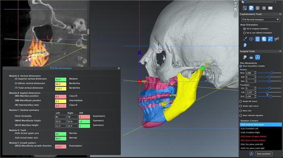 Fig. 3 - Utilizzo della cefalometria 3D TFA nel modulo di Visual Surgery Plan: Romexis 6.0/Planmeca, Helsinky, Finland.
