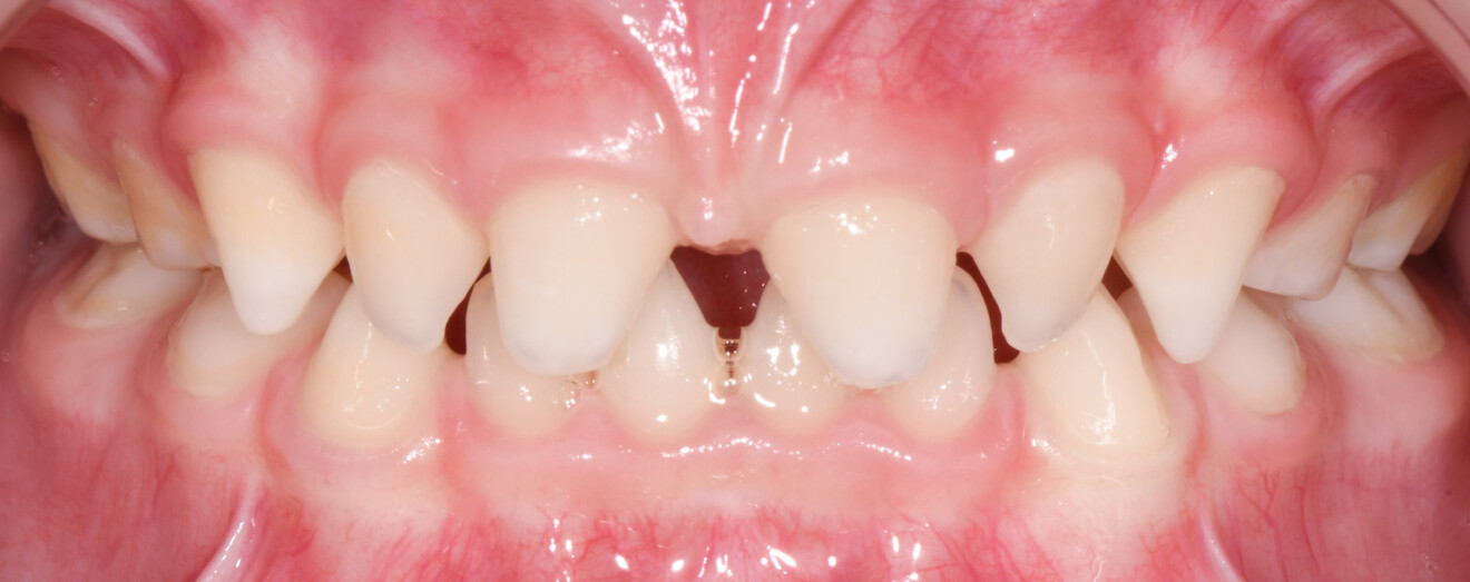 Figs. 1b–e: Initial intra-oral and extra-oral photographs presenting the main features of ectodermal dysplasia.