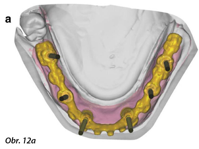 Okluzální pohled na CAD návrh definitivní fixní náhrady (a) a detailní snímek tvaru abutmentu (b).