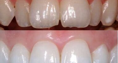 Inman Aligner: Korigovanje položaja zuba, beljenje i izrada direktnih adhezivnih restauracija – progresivni pristup preoblikovanju izgleda osmeha (Drugi deo)