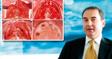 Alla ricerca della combinazione ideale tra capacità di creare spazio e ridotta invasività