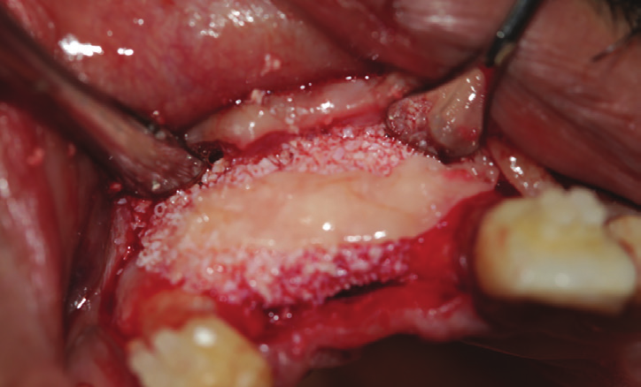 Figure 16: A combination of bovine bone and PRF, covered by first layer of L-PRF membranes that help stabilize the graft and insure hemostasis.