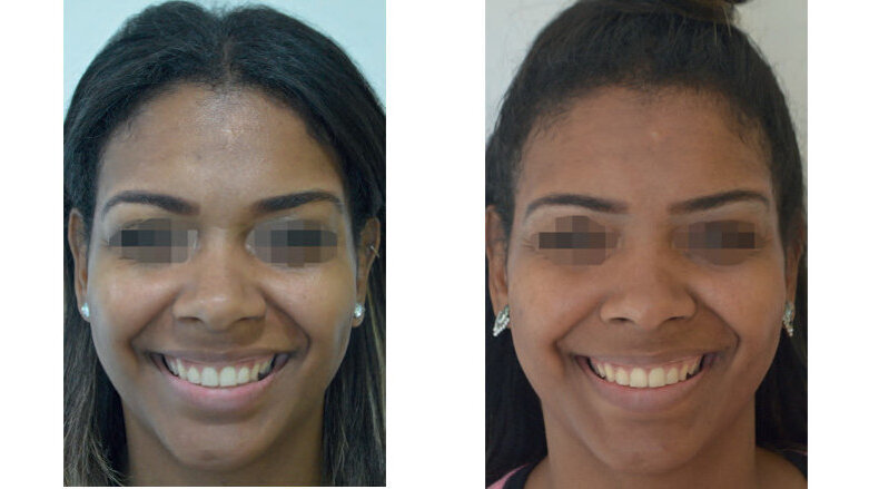 Allongement coronaire chirurgical et toxine botulinique