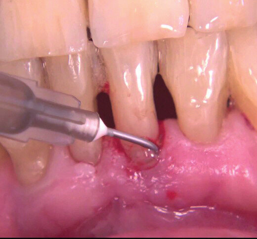 Fig. 7 - Applicazione di Ozosan.
