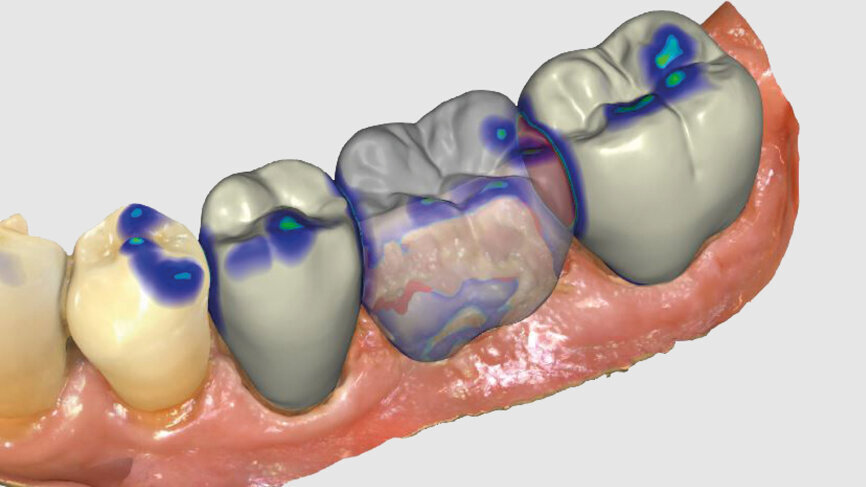 Fig. 5: Bridge design using CEREC Software.