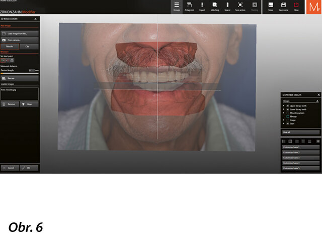 Nastavení individuálních parametrů konkrétního pacienta v programu Zirkonzahn.Archiv. V něm uložené údaje se importují do programu Zirkonzahn.Scan a dojde k fúzi dat.