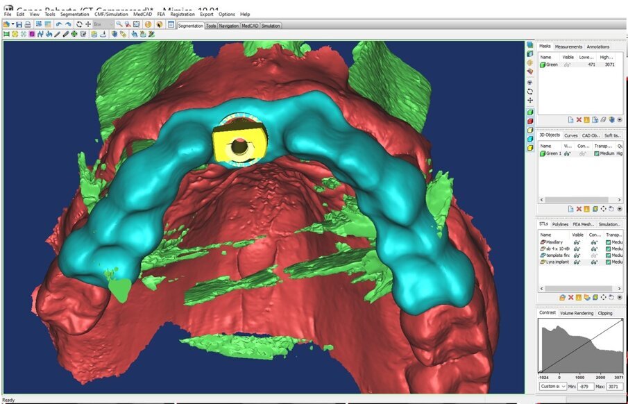 Fig. 11_La pianificazione viene validata radiologicamente. 