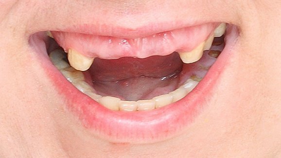 Perda de dentes pode deteriorar as funções do corpo e do cérebro