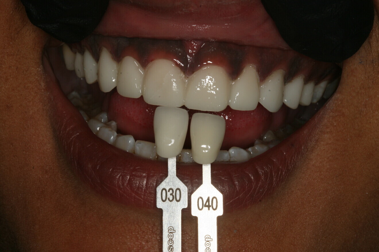Fig. 4: Planned tooth shade. 