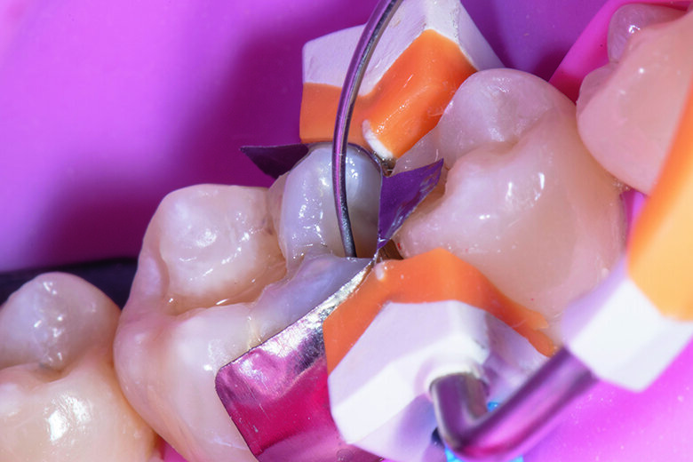 Fig. 6. Spreading of Beautifil Injectable XSL (Self-leveling composite resin) shade A2.