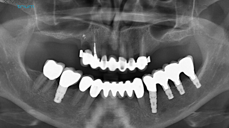 CBCT bone-densitometry for pre-surgical decision-making