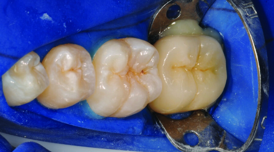 Fig. 11: Dispense 3M™ RelyX™ Ultimate Adhesive Resin Cement directly into the crown. Firmly seat the crown under finger pressure.