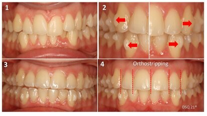 Alineadores: Biomecánica básica de los Ataches (1ª Parte)