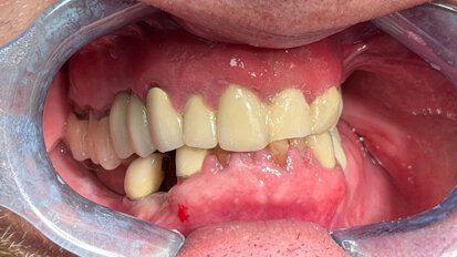Slide-and-tilt stackable surgical guides for full-arch implant reconstruction— Part 1: Maxillary arch
