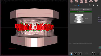 Polorto – DTS – Indirect Bracket Placement – IPA – Individually Projected Appliances