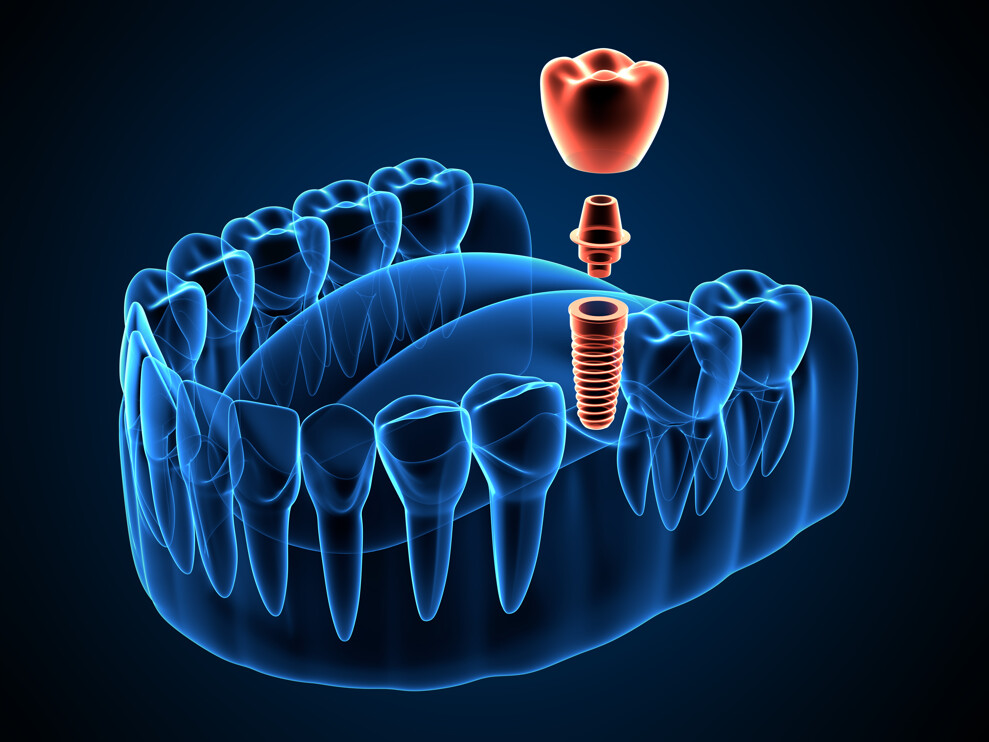 The discovery of osseointegration occurred accidentally after an unsuccessful attempt to remove a titanium chamber from a rabbit's bone. (Image: Aleksandra Gigowska/Adobe Stock)