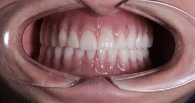 Production of complete maxillary and mandibular dentures using CAD/CAM technology