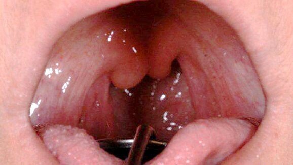 Gespleten huig indicatie voor stofwisselingsziekte