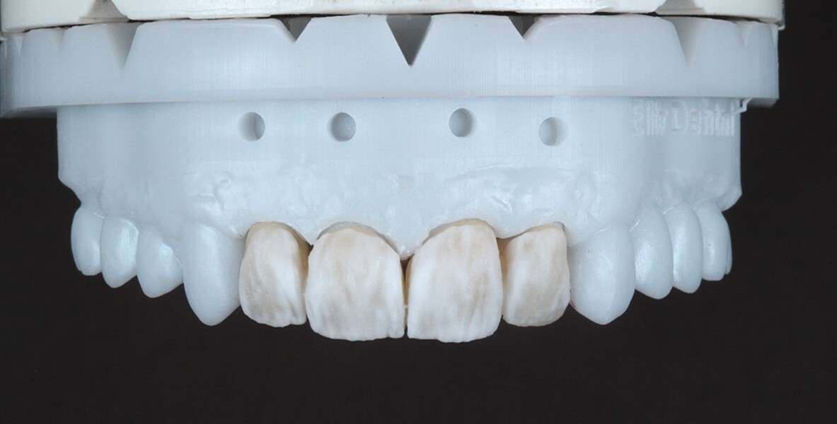Fig. 9: Restorations on the model after final layering with lustre porcelains to complete the morphology. 