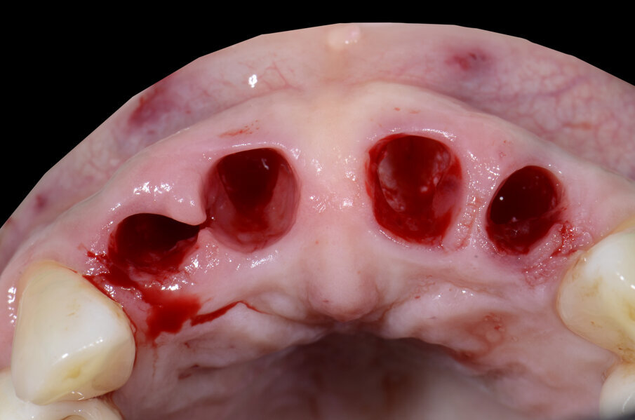 Fig. 22 - Estrazioni.