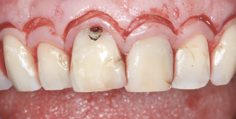 Fig. 4 - Il disegno del lembo chirurgico, sollevato solo sull’aspetto buccale.