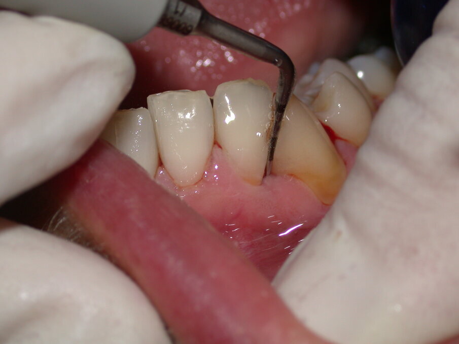 Fig. 2 - Debridement Parodontale con inserto specifico 10Z Acteon Satelec da utilizzare con basse e medie potenze.