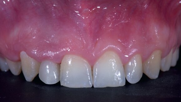 Comprehensive rehabilitation and natural esthetics with implant and orthodontics (CRANIO): An interdisciplinary approach to missing maxillary lateral incisors
