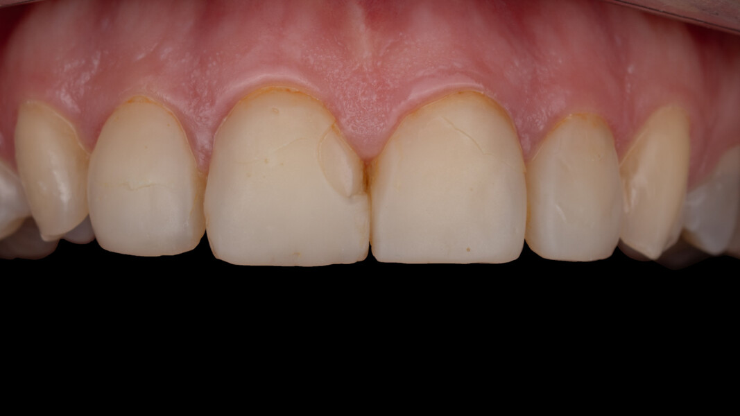 Fig. 1a: Existing resin composite veneers on the maxillary anterior teeth. Intra-oral frontal view showing aesthetic integrity issues. (Clinical images: Dr Onur Alp Yünük) 