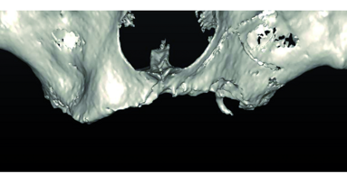 CAD/CAM custom-milled titanium bar for rehabilitation of an atrophic upper jaw