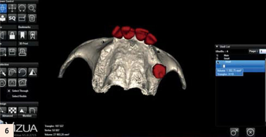 Modélisation par Vizua du modèle denté...