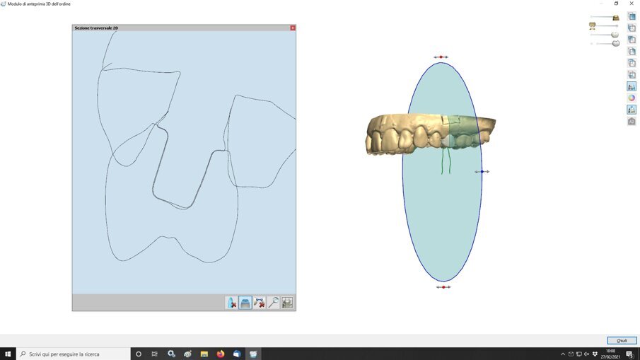 Fig. 13_Il disegno del perimetro coronale è anche possibile ruotarlo nello spazio evidenziando eventuali modifiche morfologiche da poter apportare. Condividere con l’odontotecnico tutte queste informazioni permette al clinico di raggiungere la forma voluta sulla base della conoscenza dei denti limitrofi e delle funzioni masticatorie espresse dal paziente.