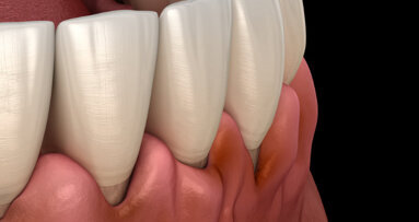 Parodontitis erhöht Krebsrisiko um bis zu 50 Prozent