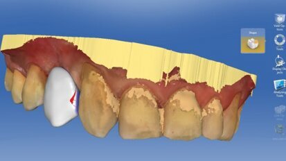 Leczenie wspomagane komputerowo z wykorzystaniem technologii CAD/CAM i CBCT
