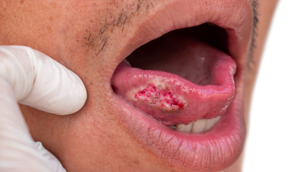 Study identifies gaps in Turkish dentists’ knowledge of oral cancer and mucosal lesions