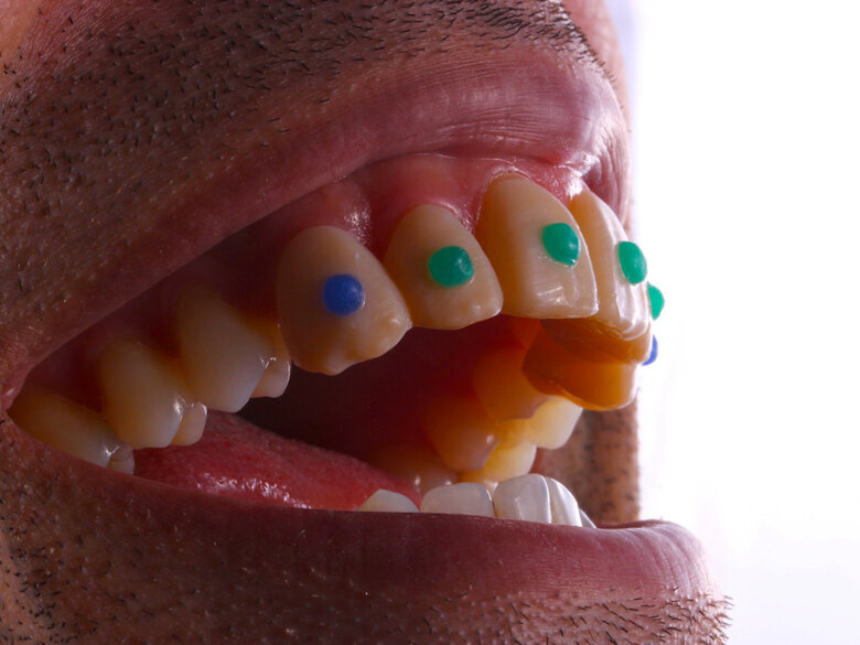 Fig. 22. Resultado final en boca del mock-up con incrustaciones de piedras al estilo maya.