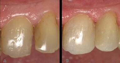 Restauraciones de clase III y IV con composite termoviscoso
