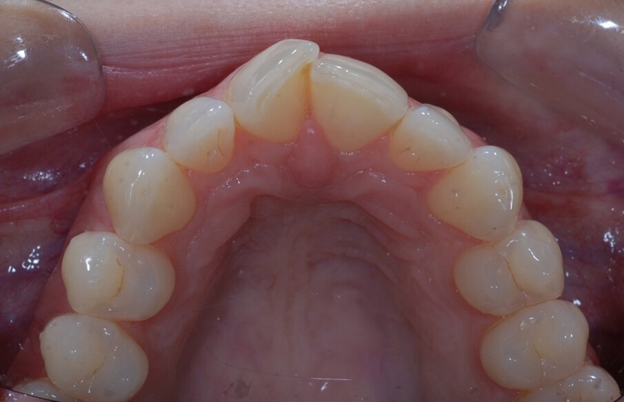 Fig. 6: Pre treatment upper occlusal