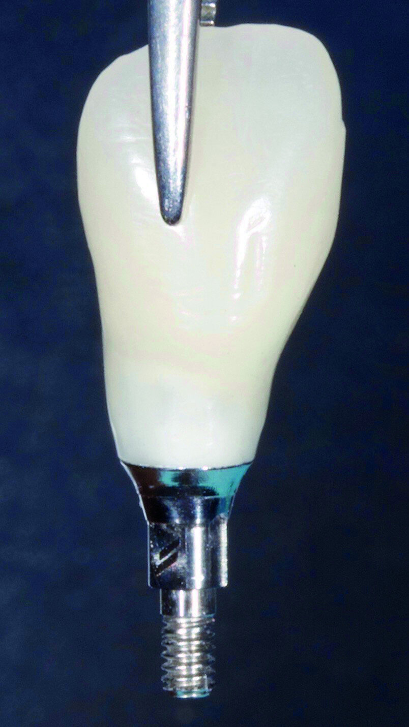 Fig. 8: Temporary crown was installed to support the formation of soft tissues.