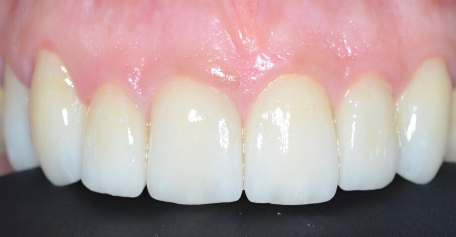 Fig. 5 - Restauri definitivi cementati.