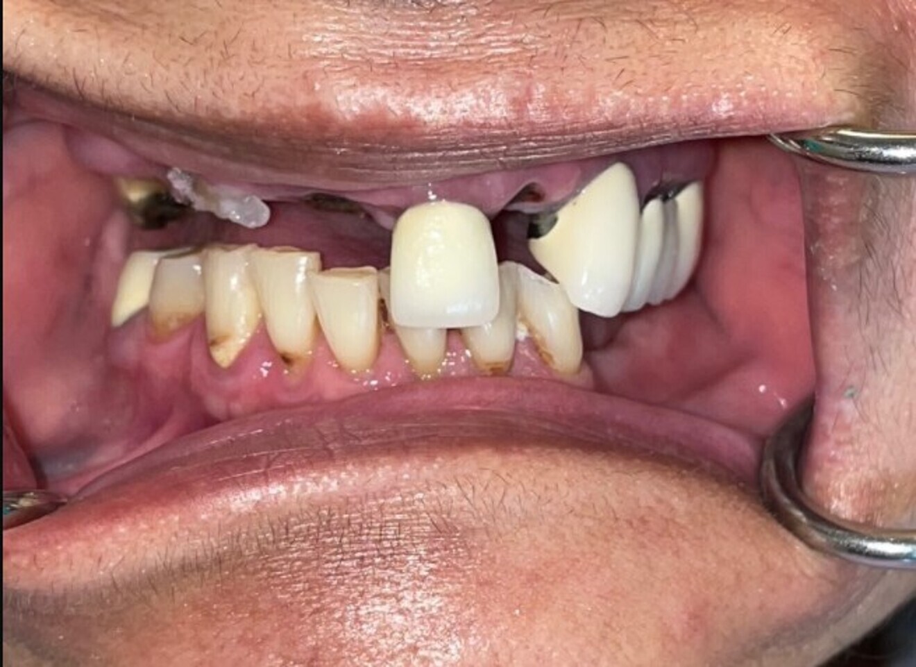 Fig. 10: Pre-op retracted view.