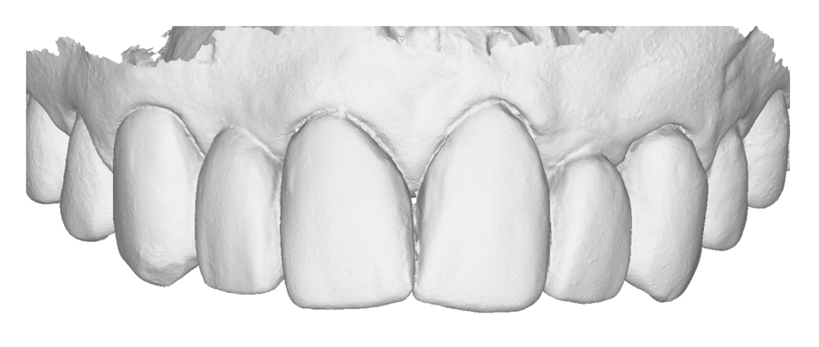 Fig. 21_Scansione dei provvisori in situ.