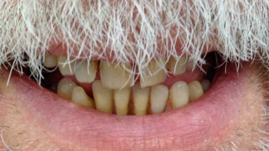 Riabilitazione implanto-protesica post-estrattiva a carico immediato secondo la tecnica All on four: un caso clinico