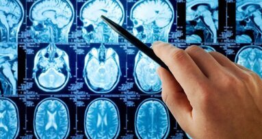 Acredita-se que infecções bucais causem aneurismas cerebrais