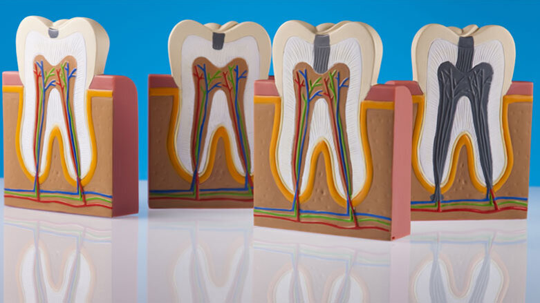 So können Peptide die Kariesbehandlung revolutionieren