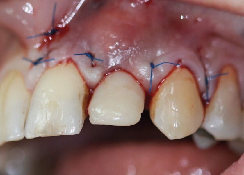 Fig. 30 : Fermeture du lambeau avec monofilament 5.0. 