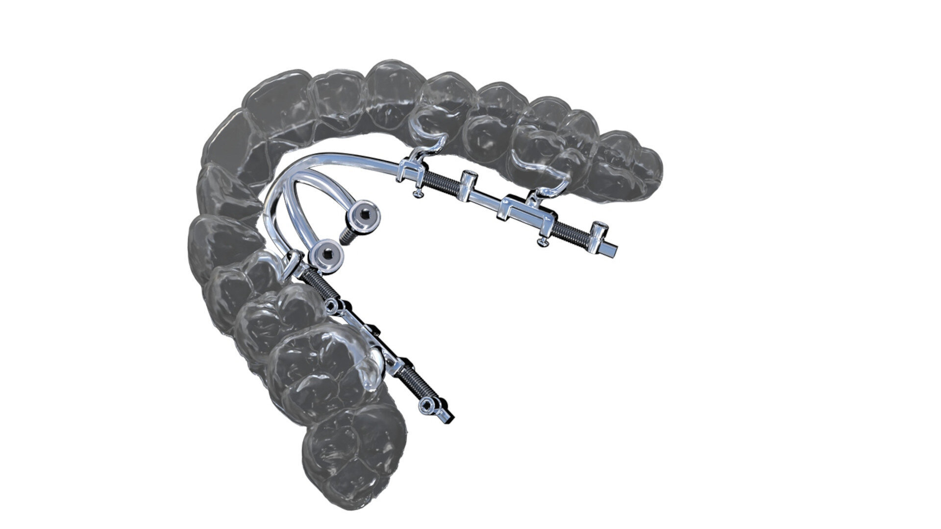 Mini-implant-borne sliders and expanders to overcome aligner limitations