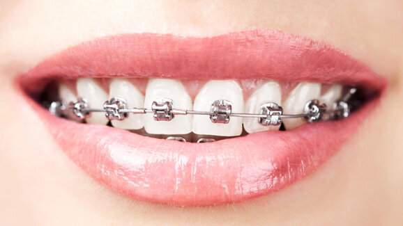 Mundhygiene-Experten forschen an neuer Bracket-Reinigung